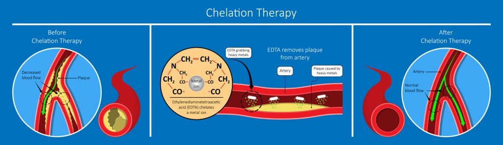 Chelation therapy detoxification banner