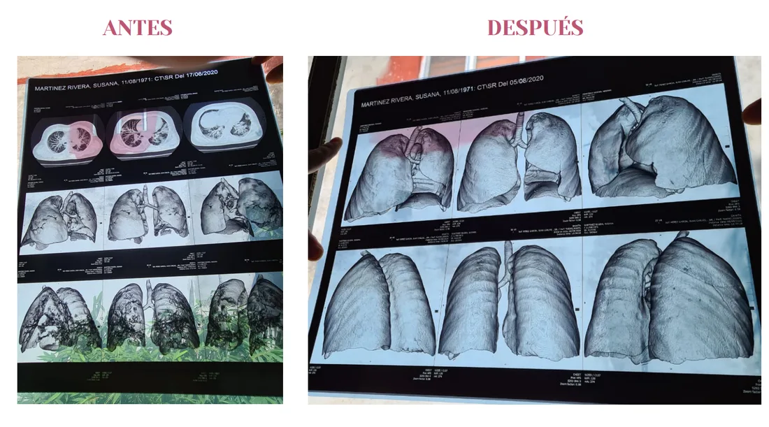 Imágenes de antes y después que muestran la mejoría del paciente tras la terapia con MSC